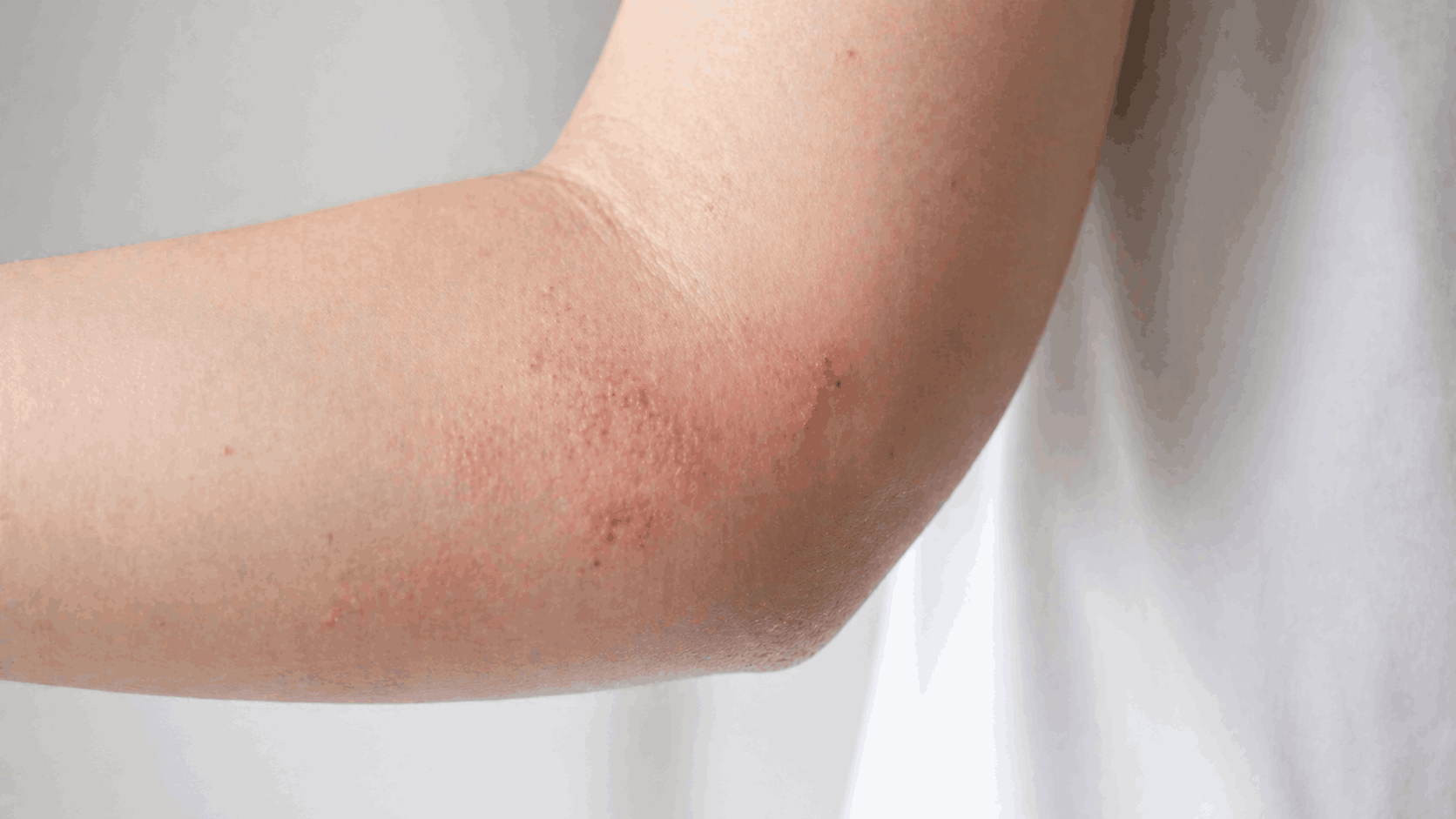 What Causes Meth Sores Symptoms, Dangers, and Treatment