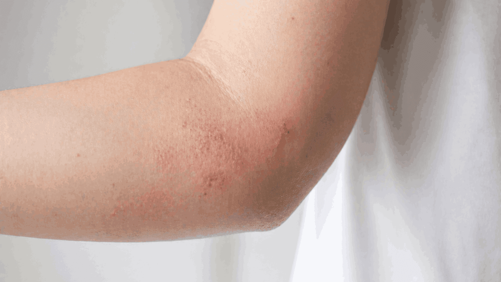 What Causes Meth Sores Symptoms, Dangers, and Treatment